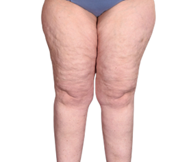 Lipoedema on a woman's upper legs