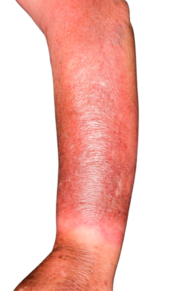 Cellulitis rash on an arm