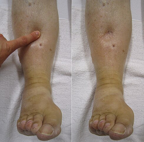 Pitting odema during and after the application of pressure to the skin. 